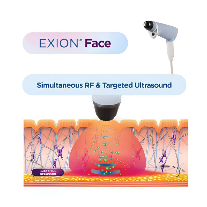 EXION